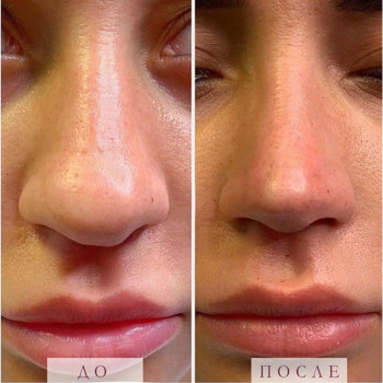 Уменьшение носика липолитиком
                    Косметолог Ксения Кропивницкий