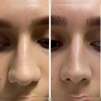 Уменьшение носика липолитиком
                    Косметолог Ксения Кропивницкий