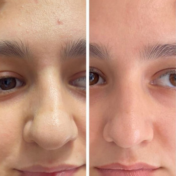 Уменьшение носика липолитиком
                    Косметолог Ксения Кропивницкий