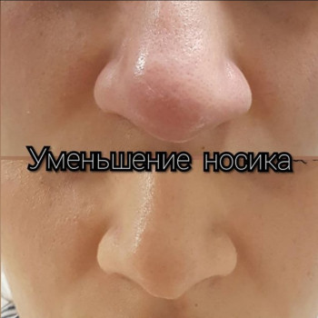 Уменьшение носика липолитиком
                    Косметолог Ксения Кропивницкий