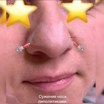 Уменьшение носика липолитиком
                    Косметолог Ксения Кропивницкий