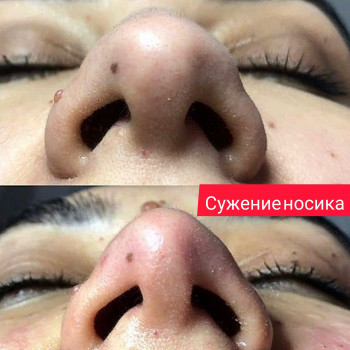 Уменьшение носика липолитиком
                    Косметолог Ксения Кропивницкий