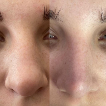 Уменьшение носика липолитиком
                    Косметолог Ксения Кропивницкий