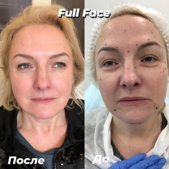 Ботокс
                    Косметолог Ксения Кропивницкий