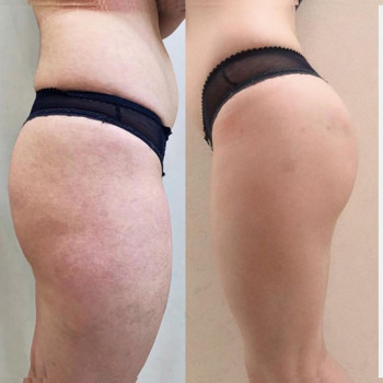 Коррекция ягодиц
                    Косметолог Ксения Кропивницкий