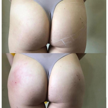 Коррекция ягодиц
                    Косметолог Ксения Кропивницкий