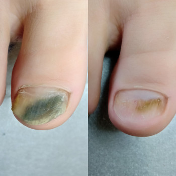 Лікування грибкового ураження
                    Преподаватель курсов красоты Екатерина Запорожье