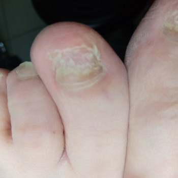 Лікування грибкового ураження
                    Преподаватель курсов красоты Екатерина Запорожье