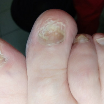 Лікування грибкового ураження
                    Преподаватель курсов красоты Екатерина Запорожье