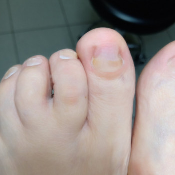 Лікування грибкового ураження
                    Преподаватель курсов красоты Екатерина Запорожье