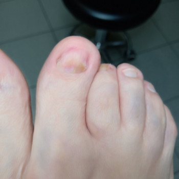 Лікування грибкового ураження
                    Преподаватель курсов красоты Екатерина Запорожье