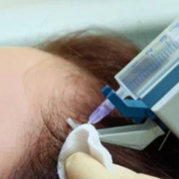 Мезотерапия для роста волос
                    Косметолог Ирина Київ