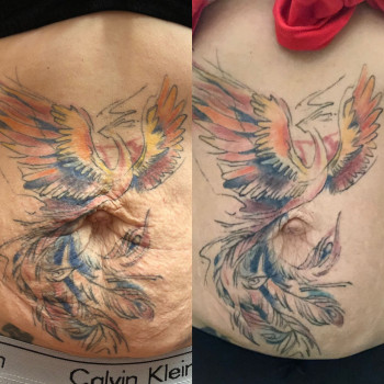 Аппаратная мезотерапия и РФ- лифтинг