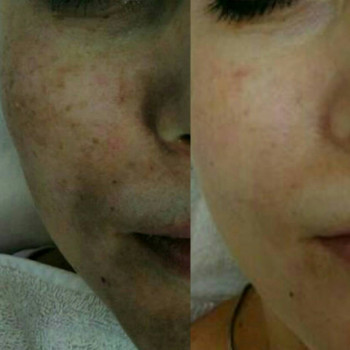 Дермабразия и аппаратная мезотерапия