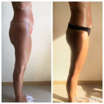 ЛЕПКА Ручной антицеллюлитный массаж
                    СПА-салон GARNA Мариуполь