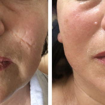 RF-lifting лица
                    СПА-салон GARNA Маріуполь