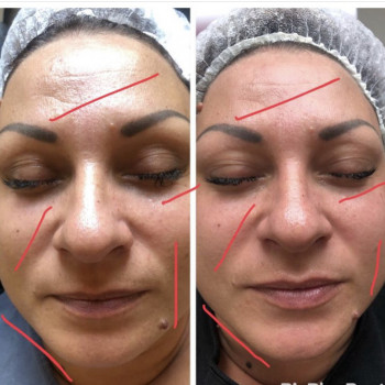 RF-lifting лица
                    СПА-салон GARNA Маріуполь