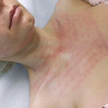 Мезотерапия