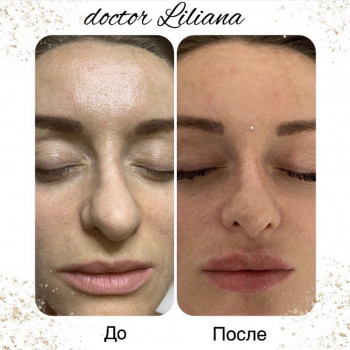 Уменьшение формы носа