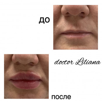 Аугментация губ