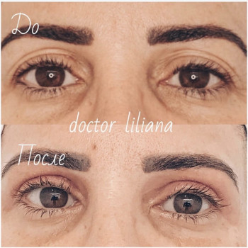 Безоперационная блефаропластика верхних век