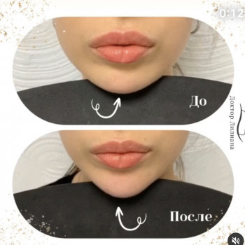 Контурная пластика