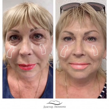 Безоперационная блефаропластика