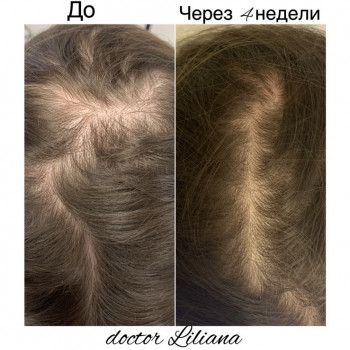 Лечение выпадения волос