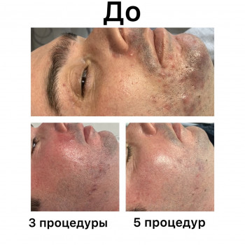 Лечение проблемной кожи