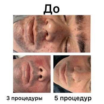 Лечение проблемной кожи