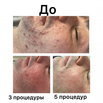 Лечение проблемной кожи