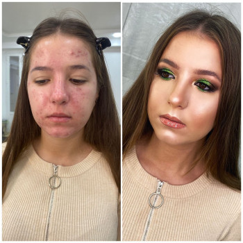 пример работы с проблемной кожей