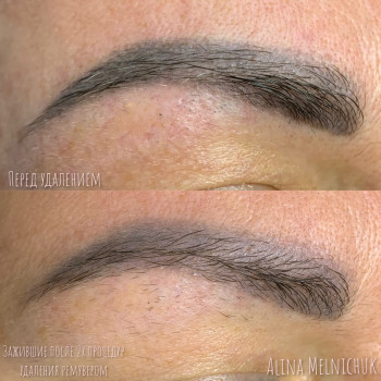 Удаление перманентного макияжа, татуажа
                    Мастер перманентного макияжа Алина Киев