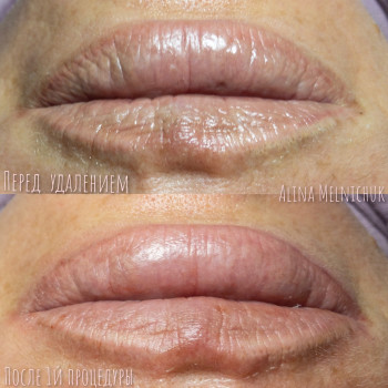 Удаление перманентного макияжа, татуажа
                    Мастер перманентного макияжа Алина Киев