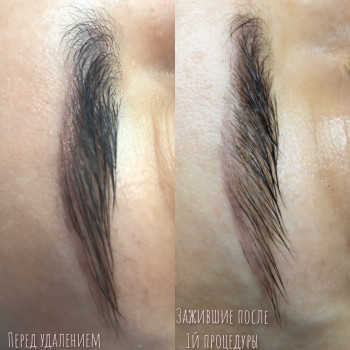 Удаление перманентного макияжа, татуажа
                    Мастер перманентного макияжа Алина Киев