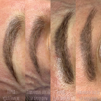 Удаление перманентного макияжа, татуажа
                    Мастер перманентного макияжа Алина Киев