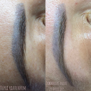 Удаление перманентного макияжа, татуажа
                    Мастер перманентного макияжа Алина Киев