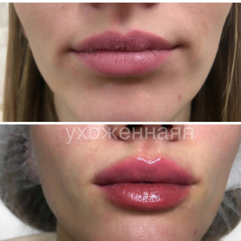 Увеличение губ