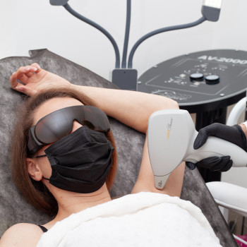 Лазерная эпиляция