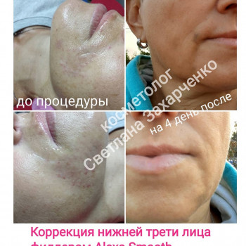 Корекція зморшок нейропептидом #ботулотоксину типа А