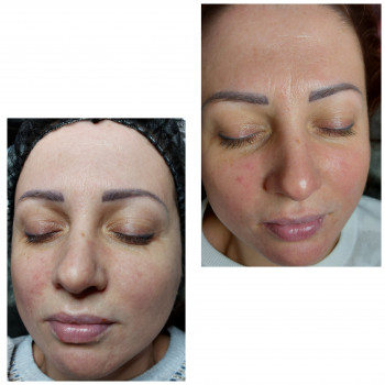 Лечение купероза