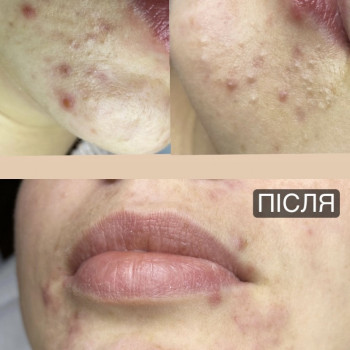 Комбинированая чистка лица
                    Косметолог-инъекционист Юлия Полтава