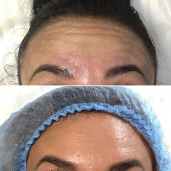 Инъекции ботулотоксина, зона лба