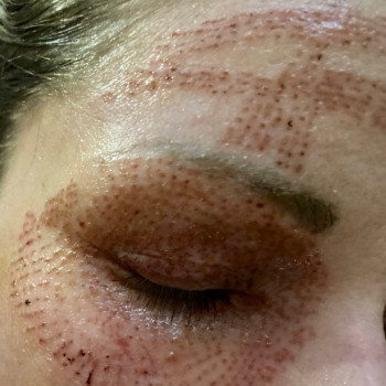 Плазма пен
                    Косметолог Мария Київ