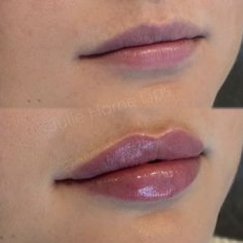 Увеличение губ (cертифицированный препарат)
                    Косметолог-ін'єкціоніст Наталия Одеса