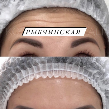 Ботулотоксин
                    Врач-косметолог Наталия Киев