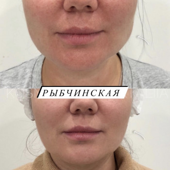 Ботулотоксин
                    Врач-косметолог Наталия Киев