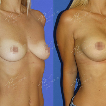 увеличение груди