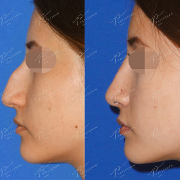 ринопластика