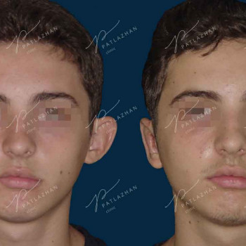 отопластика